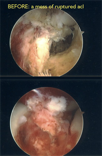 acl_series1_copy.jpg